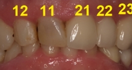 Entzündetes Zahnfleisch und verfärbte Zähne vor der Behandlung mit dem CEREC-Verfahren.