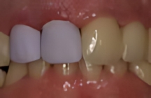 Rekonstruierte Zähne mit dem CEREC-Verfahren.