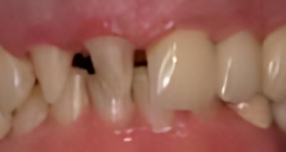 Zähne eines Patienten vor einer CEREC-Behandlung.