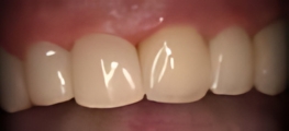 Nachher-Bild der Zähne nach der Behandlung mit dem CEREC-Verfahren.