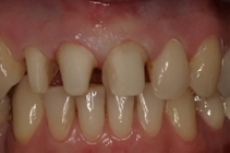 Beschädigte Zähne eines Patienten vor der Zahnersatz-Behandlung.