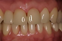 Nachher-Foto der Zähne nach der Behandlung mit dem CEREC-Verfahren.